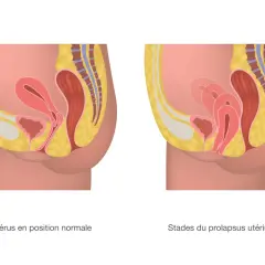 Comparaison d'un utérus en position normale et d'un prolapsus utérin stade 4, où l'organe descend significativement.