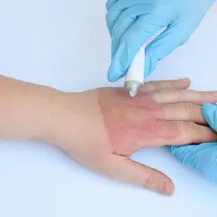 Behandlung einer leichten **Verbrennung 1. Grades** am Handrücken mit Salbe.