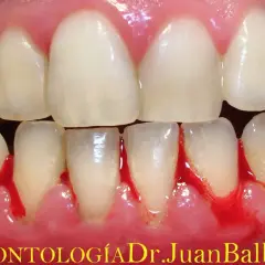 Encías inflamadas y sangrantes, un claro signo de gingivitis. La salud bucal es importante.