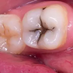 Dente con carie profonda che necessita di cure. La cavità scura è ben visibile nella fessura centrale.