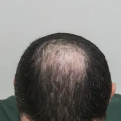 Vista superior de la cabeza de un hombre mostrando la pérdida de cabello, un ejemplo de alopecia androgénica que es común.
