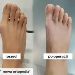 Ból po operacji haluksa: Co jest normą, a co powinno martwić?
