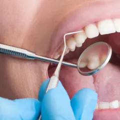 Bocca aperta con strumenti dentistici. La pulizia dei denti fa male? Forse, ma necessaria per un sorriso smagliante.