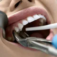 Dentysta usuwa ząb z powodu choroby. Widoczne są kleszcze dentystyczne i białe zęby.