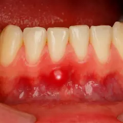 Una piccola bolla sulla gengiva, rossa e gonfia, vicino ai denti inferiori.