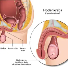 Anatomische Darstellung des männlichen Beckens mit Fokus auf den Hoden. Ein vergrößerter Hoden mit tastbarer Knotenbildung zeigt Hodenkrebs Symptome.