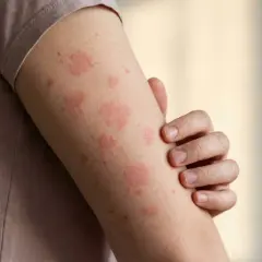 Haut rot aber kein Sonnenbrand: rote Flecken auf dem Arm, die jucken könnten.