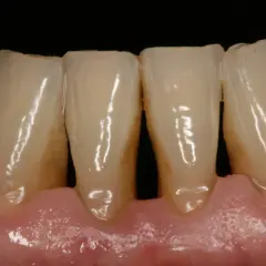 Dientes con acumulación de sarro y encías inflamadas, signos de periodontitis causas.