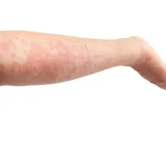 Braccio di un bambino con eruzioni cutanee rosse e pruriginose, indicative di orticaria neonato. Segni viola indicano aree di test.
