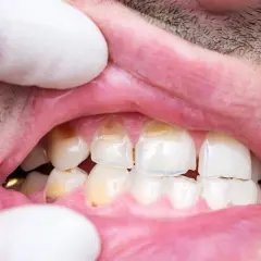 Dientes con manchas y aspecto desgastado, sugiriendo hipoplasia dental.
