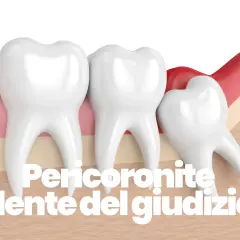 Dente del giudizio parzialmente coperto dalla gengiva, causa di pericoronite.