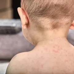 Skóra dziecka pokryta drobnymi, czerwonymi wykwitami, które mogą być objawem trzydniówki.