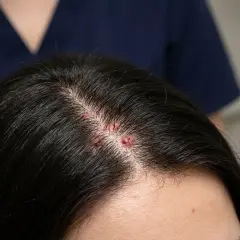 Lesiones rojas y con costra en el cuero cabelludo, indicativas de foliculitis.