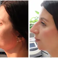Profil twarzy przed i po korekcie zgryzu głębokiego. Widoczna zmiana linii żuchwy i podbródka.