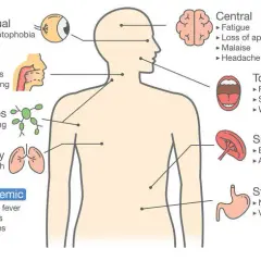 Síntoma de la mononucleosis: identifica los signos y evita complicaciones