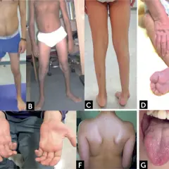 Manifestaciones de atrofia muscular espinal: piernas delgadas (A, B, C), pie equino (D), manos con dedos finos (E), espalda con escápulas prominentes (F) y lengua con fasciculaciones (G).