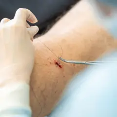 Chirurg zszywa ranę po usunięciu pieprzyka na nodze pacjenta.