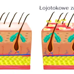 Ilustracja porównująca zdrową skórę głowy z łojotokowym zapaleniem skóry, pokazująca mieszki włosowe i gruczoły łojowe.