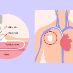 Schema zeigt, wo ein Port gelegt wird: eine Nadel in der Kammer, die mit dem Portkatheter verbunden ist, welcher in eine Vene führt.