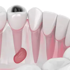Dente cariato con ascesso gengivale. Si cercano rimedi della nonna, ma la situazione richiede attenzione medica.