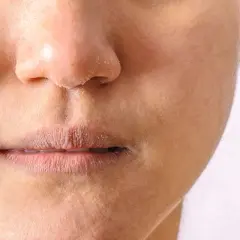 Nahaufnahme eines Gesichts mit trockener, schuppiger Haut um Mund und Nase, was auf periorale Dermatitis am Kinn hindeuten könnte.