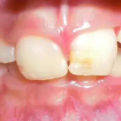 Dientes infantiles con caries incipiente. El flúor ayuda a fortalecer el esmalte y previene futuras caries.