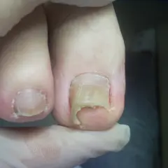 Zniszczone paznokcie u nóg, wymagające profesjonalnego pedicure.