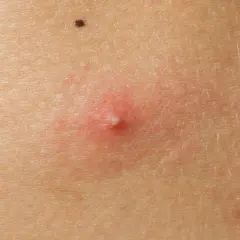 Jak pozbyć się pryszczy na plecach? Sprawdzone metody i porady