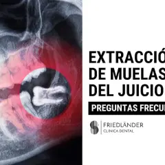 Radiografía dental muestra la extracción de muelas del juicio. Texto: "Extracción de Muelas del Juicio. Preguntas Frecuentes.