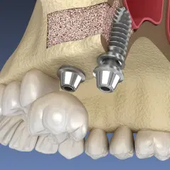 Model szczęki z implantami i podniesionym dnem zatoki szczękowej. Zabieg sinus lift pozwala na wszczepienie implantów w przypadku braku kości.