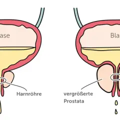Vergleich von normaler und vergrößerter Prostata. Die vergrößerte Prostata kann zu verengter Harnröhre und damit zu Problemen beim Wasserlassen führen, ein mögliches Prostata Symptom.