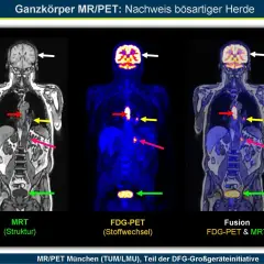Ganzkörper-PET-CT-Bilder zeigen bösartige Herde. Pfeile markieren Auffälligkeiten in Gehirn, Brustkorb und Becken.