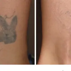 Przed i po zabiegu: jak usunąć tatuaż. Widoczny efekt redukcji ciemnego wzoru na skórze.