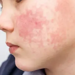 Visage d'enfant marqué par une rougeur diffuse et des plaques, symptômes de dermatite atopique aggravée par la transpiration.
