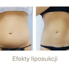 Po liposukcji tłuszcz wraca? Nie! Jak utrzymać nową sylwetkę