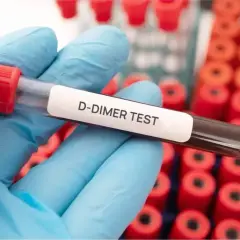 Ręka w niebieskiej rękawiczce trzyma probówkę z napisem "D-DIMER TEST". W tle widać rząd czerwonych probówek. Badanie d-dimery a stan zapalny.