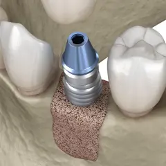 Impianto dentale inserito nell'osso mascellare, pronto per l'integrazione. L'osso autologo offre una base solida per il successo del trattamento.