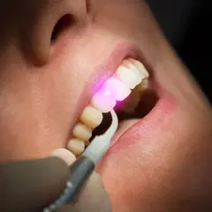 Trattamento gengivale con laser, un raggio rosa illumina i denti e le gengive.