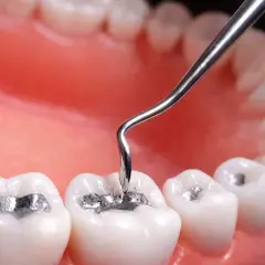 Un dentista aplica una amalgama dental a una muela.
