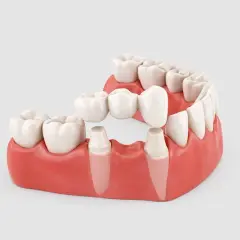 Modello di un ponte dentale con ganci che sostituisce un dente mancante, ancorato a pilastri naturali.
