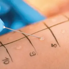 Allergietest auf der Haut: Eine Nadel mit einer Flüssigkeit wird auf markierte Felder aufgetragen, um eine mögliche eibisch allergie zu identifizieren.