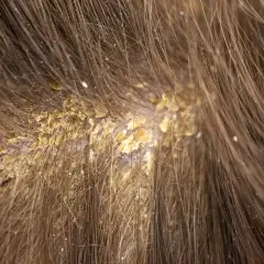 Costras amarillentas y descamación en el cuero cabelludo, resultado de quemaduras por decoloración.