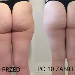 Masaż bańką chińską na cellulit: Instrukcja krok po kroku i efekty