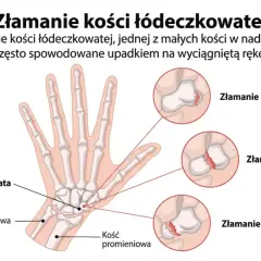 Ilustracja przedstawia złamanie kości łódeczkowatej nadgarstka, z zaznaczonymi miejscami pęknięcia: dalszym, trzonu i bliższym.