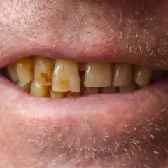 Primer plano de una boca con dientes amarillentos y manchas de esmalte.