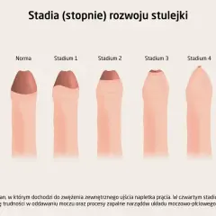 Ilustracja przedstawia stadia rozwoju stulejki, od normy do stadium 4, pokazując stopniowe zwężenie napletka.