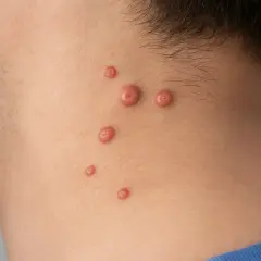 Molluschi sulla pelle di un bambino, piccole protuberanze rosee che compaiono sul collo.
