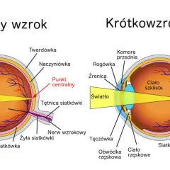 Porównanie budowy oka z krótkowzrocznością i normalnym wzrokiem. Światło skupia się przed siatkówką.