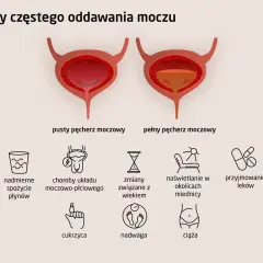 Ilustracja przedstawia pęcherz moczowy pusty i pełny, wyjaśniając przyczyny częstego oddawania moczu, w tym poliurię, np. nadmierne picie, choroby, wiek, leki, cukrzycę, nadwagę, ciążę.
