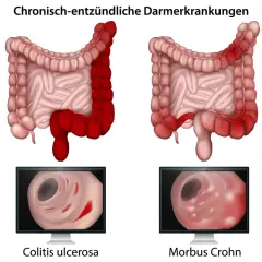Morbus Crohn Symptome: Erkennen Sie die alarmierenden Anzeichen